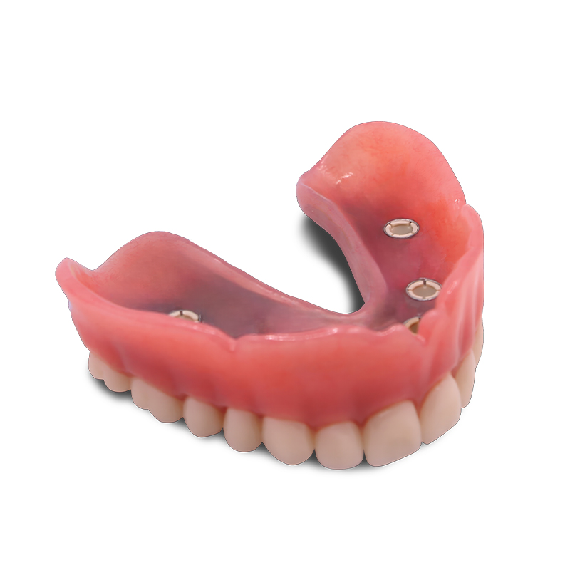 AvaMax Overdenture